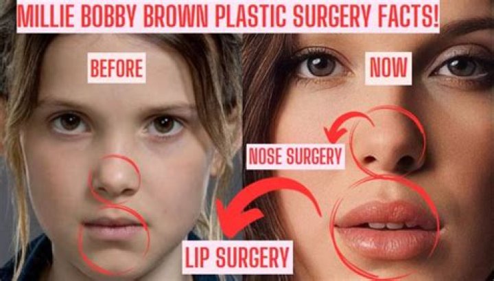 Has Millie Bobby Brown Done Lip Filler? Fans Suspect Botox And Nose Job!