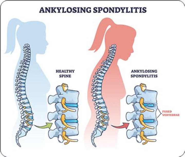 
The Truth About Mick Mars and His Struggles With Ankylosing Spondylitis 